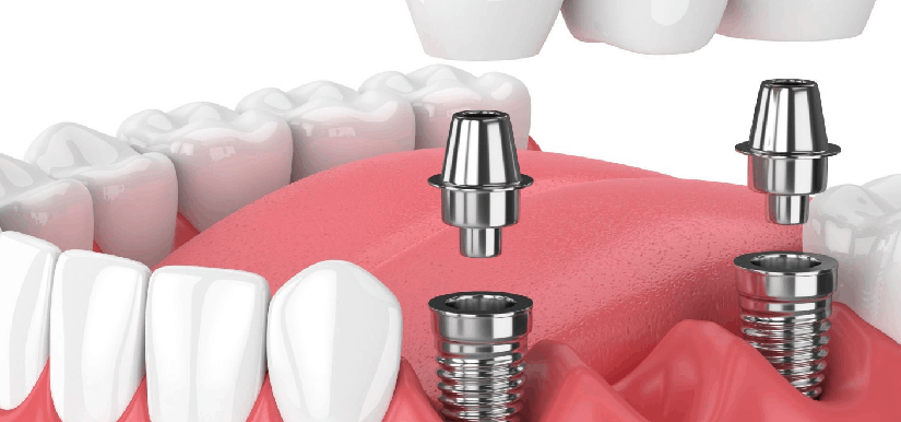 آیا ایمپلنت دندان عوارضی دارد؟  –