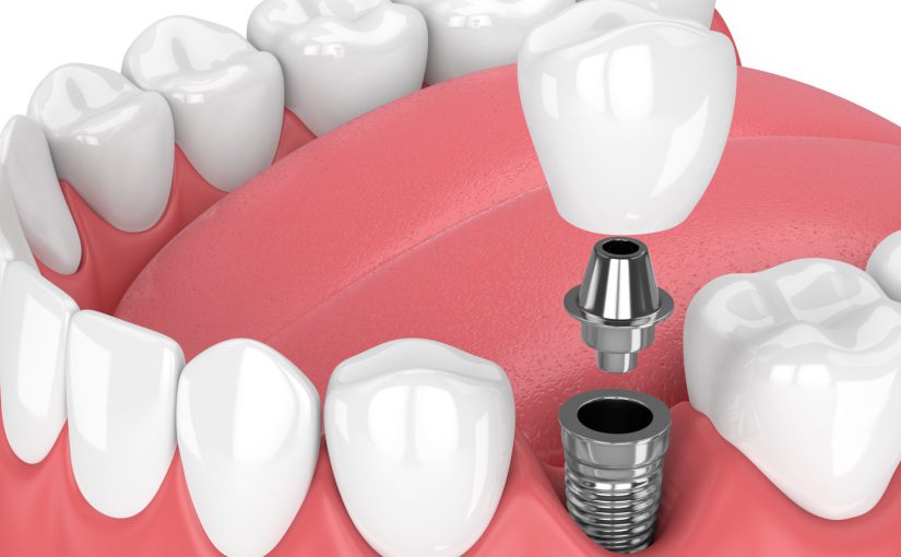 از دست دادن یک دندان – درمان ایمپلنت تک دندان