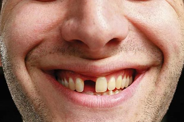 دندان از دست رفته چیست؟  چگونه دندان از دست رفته را درمان کنیم؟
