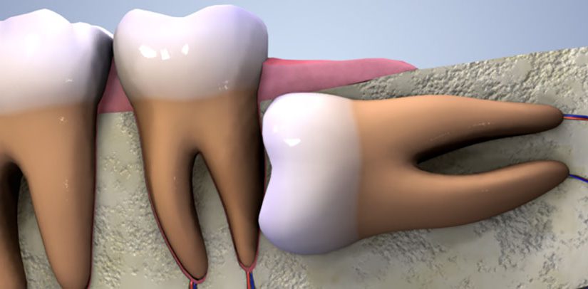 اگر دندان عقل کشیده نشود چه اتفاقی می افتد؟