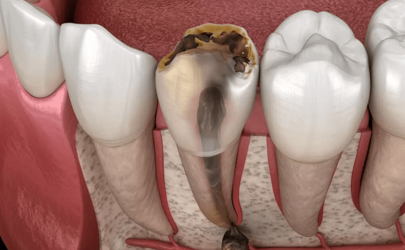 دندان مرده چقدر می تواند در دهان بماند؟  –