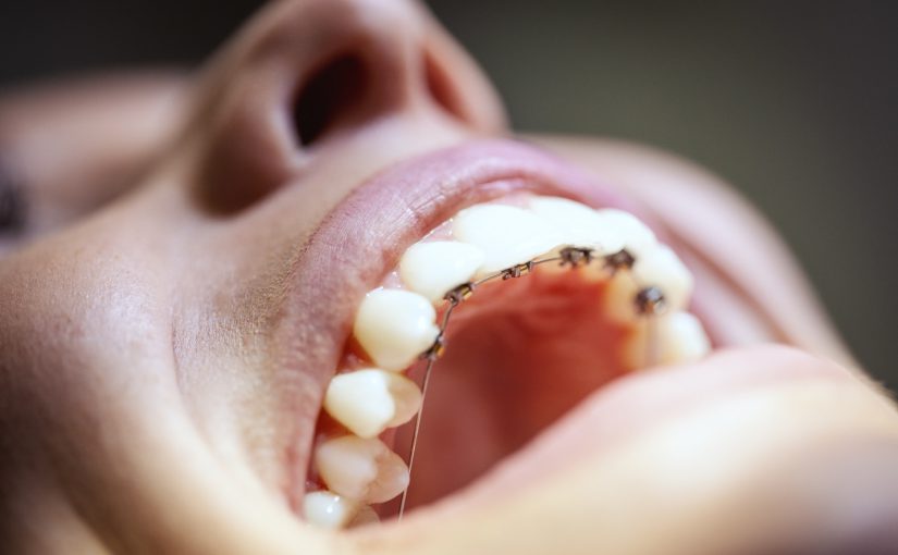 ارتودنسی لینگوال چیست – کلینیک دندانپزشکی گونزالس باکورو