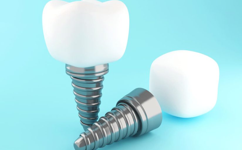 Descubre cuáles son las partes de un implante dental