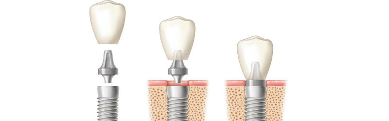 Precio Implantes Dentales Madrid 2024- Clínica dental González Baquero